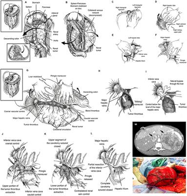 Resection of Large Urological Tumors With or Without Inferior Vena Cava Extension in Jehova's Witnesses